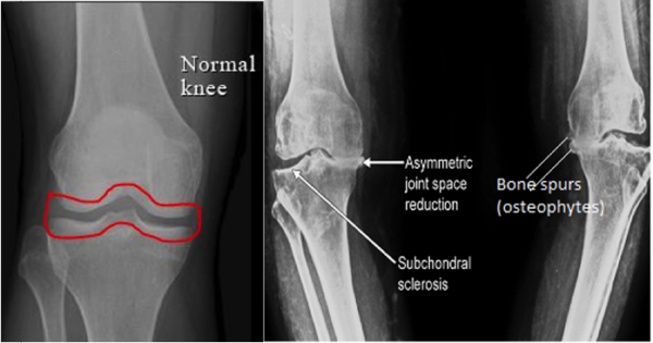 Knee Replacement Ligaments And Joints Suregery 4975