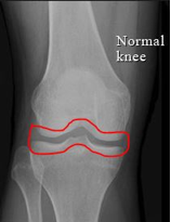 Knee pain in the old age due to Osteoarthritis - Ligaments and Joints