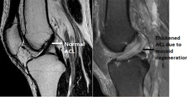 Mucoid degeneration of anterior cruciate ligament (ACL) - Ligaments and ...