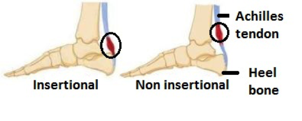 Sever's Disease - Child Foot Pain