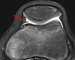 MRI showing thickened medial plica